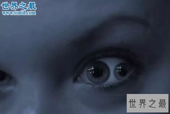 世界十大最奇葩的怪病,双瞳人最吓人(图)