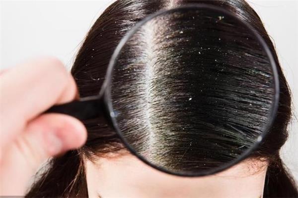头屑是因为头皮干燥吗 头屑是缺什么维生素
