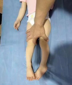 ​罗圈腿怎么办如何自我进行矫正？