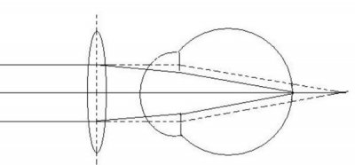 ​远视戴隐形眼镜好不好（远视眼如何治疗）