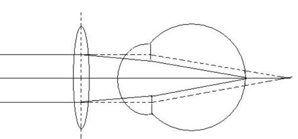 远视戴隐形眼镜好不好（远视眼如何治疗）(1)_