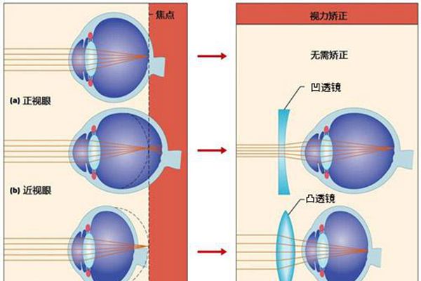 远视戴隐形眼镜好不好（远视眼如何治疗）(2)_