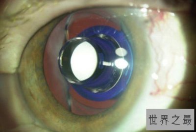 ​世界上最小的望远镜，植入眼球的望远镜