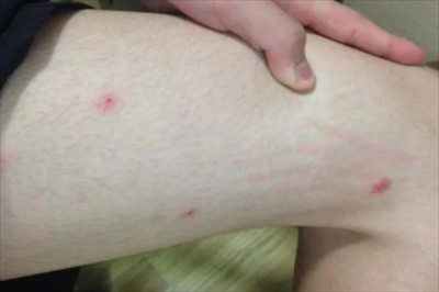 ​螨虫叮咬后的症状图：瘙痒难以接受(皮肤变粗糙)