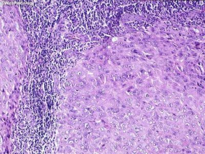 ​透明细胞肉瘤(哪些肉瘤容易出现淋巴结转移？)