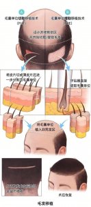 ​植发到底是什么意思 植发是什么概念