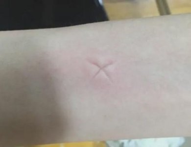 ​蚊子包怎么快速消肿止痒用什么药？蚊子包怎么快速消肿止痒红霉素