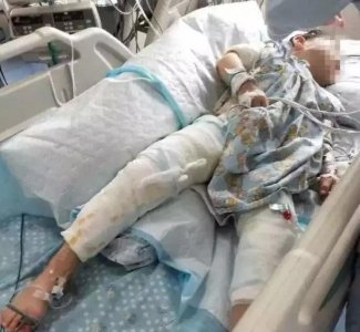 ​心痛！杭州4岁男孩一屁股坐进开水桶