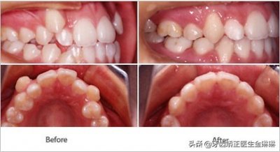 ​牙齿正畸前后变化大吗？带你看牙齿矫正变化图